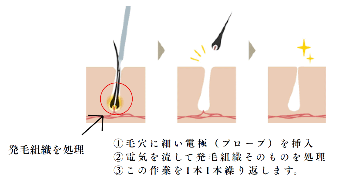美容電気脱毛イメージ