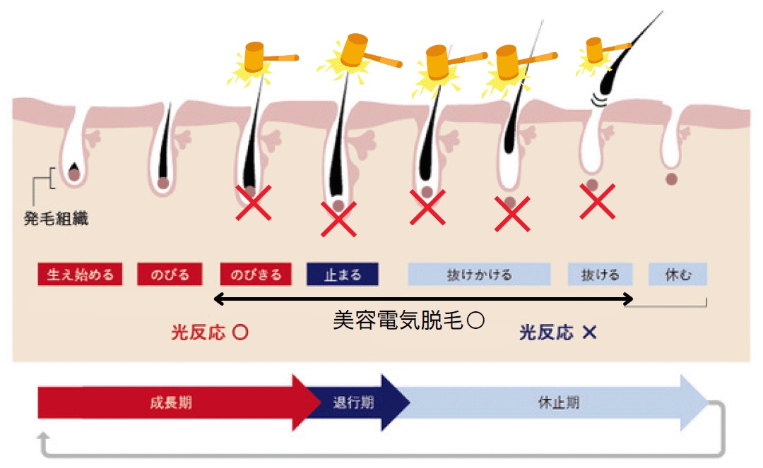ヘアサイクル関係なく毛が出てれば脱毛できる