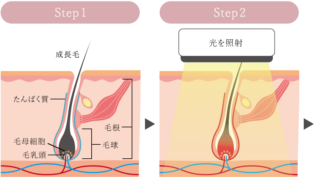 脱毛のプロセス