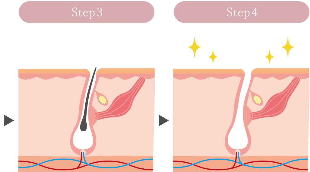 脱毛のプロセス