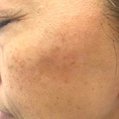 Dr.PUR BEAUTEご利用後