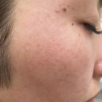 Dr.PUR BEAUTEご利用後