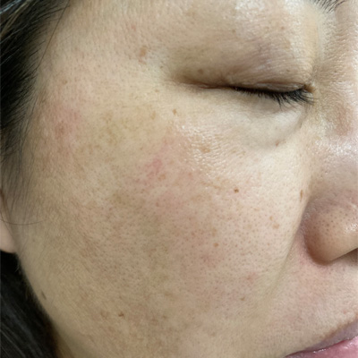 Dr.PUR BEAUTEご利用後