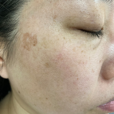 Dr.PUR BEAUTEご利用前