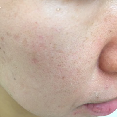 Dr.PUR BEAUTEご利用後