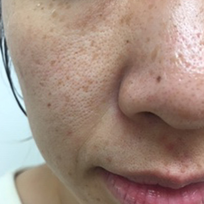 Dr.PUR BEAUTEご利用前