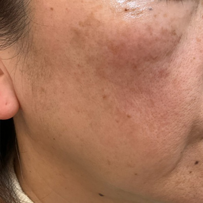 Dr.PUR BEAUTEご利用後