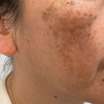 Dr.PUR BEAUTEご利用前